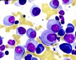 Investigan una nueva diana terapéutica para el tratamiento de la leucemia mieloide crónica