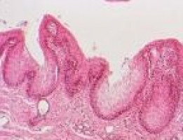 Descubren mutación genética que causa cáncer de hígado