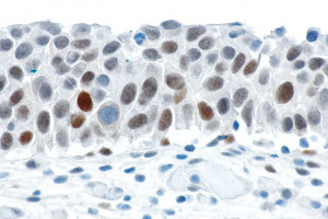 Some p53 mutations could help fight cancer