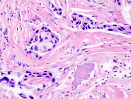 Potential new approach to treat HER2 positive breast cancer