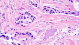 Potential new approach to treat HER2 positive breast cancer