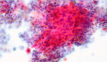 WCLC 2022: Study discloses clinical-relevant intertumoural heterogeneity of NSCLC driven by MET exon 14 skipping