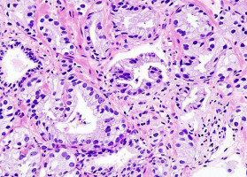 The newest precision medicine tool: Prostate cancer organoids