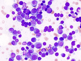 Study shows benefits of continuous treatment of lenalidomide plus dexamethasone in multiple myeloma