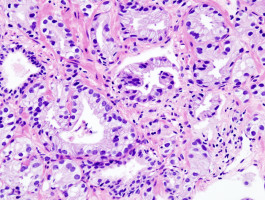 Biologists identify key step in lung cancer evolution