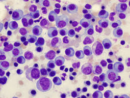 Investigational oral drug combo shows promise for newly diagnosed multiple myeloma