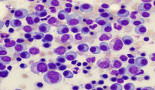 Investigational oral drug combo shows promise for newly diagnosed multiple myeloma