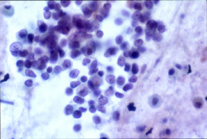 AACR 2015: 'Liquid biopsy' may help earlier detection of lung cancer treatment resistance