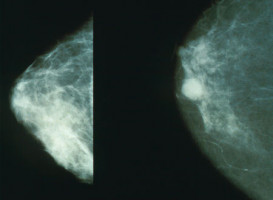 AACR 2015: Black women found to have denser breast tissue than white women