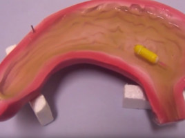 Tadpole endoscope offers new diagnosis options