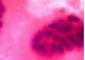 Ahora, el cáncer de mama es igual de común entre las negras y las blancas