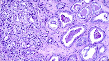 New theranostic agents show efficacy in prostate cancer treatment in preclinical studies