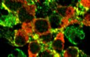 Proton therapy for prostate cancer is advantageous to IMRT according to new study