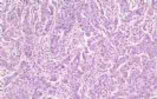 Study suggests that annual CA125 screening may reduce ovarian cancer deaths