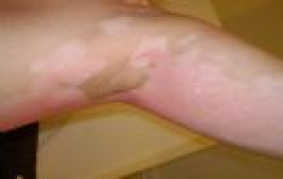 Immunity against melanoma is only skin deep