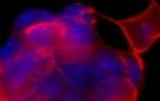 ESMO 2014: Sentinel node biopsy safe for pregnant women with cancer
