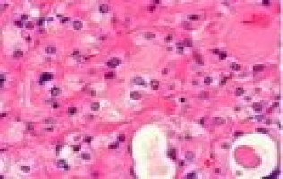 Particle accelerator waste could help produce cancer-fighting materials, study suggests