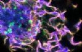 Biologists identify key step in lung cancer evolution