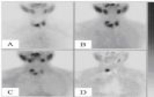 New nanoparticle technology developed to treat aggressive thyroid cancer