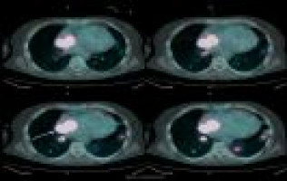 FDG-PET scanning evaluates immunotherapy for non-small cell lung cancer