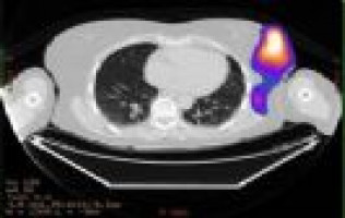 Real time visualisation of radiofrequency ablation