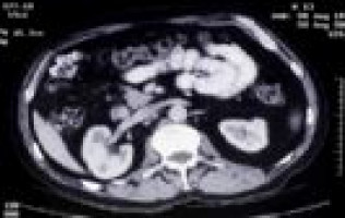 Combining radiation and immunotherapy shows promise for bladder cancer