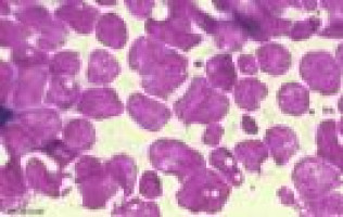 UCLA researchers discover aggressive prostate and lung cancers are driven by common mechanisms