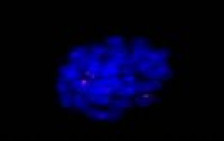 New therapeutic approach against leukaemia