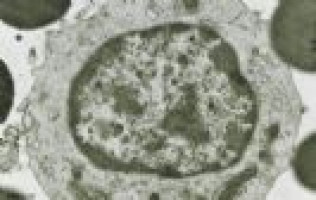 Researchers identify factors to predict severe toxicities in CAR T patients