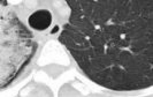 New method for non-invasive prostate cancer screening