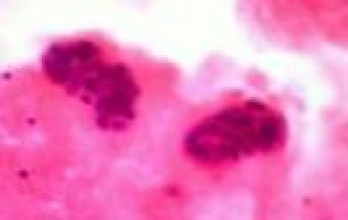 ESMO 2025: ADC improves outcomes for patients with advanced triple-negative breast cancer who are ineligible for immune checkpoint inhibitors