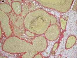 SABCS 2019: Extended letrozole therapy improves disease-free survival in postmenopausal women with HR-positive  breast cancer
