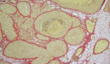 SABCS 2019: Extended letrozole therapy improves disease-free survival in postmenopausal women with HR-positive  breast cancer