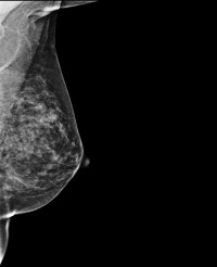 Tomosynthesis outperforms digital mammography in five-year study