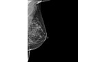 Tomosynthesis outperforms digital mammography in five-year study
