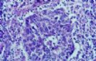 ASTRO: Select group of stage IV lung cancer patients achieve long-term survival after aggressive treatments