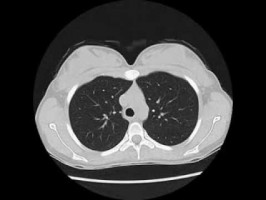 Statement published on pairing smoking cessation with lung cancer screening