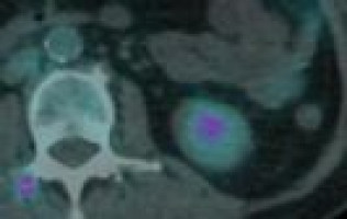 COX-2 over-expression induced by tyrosine kinase inhibitors detected by fluorocoxib A in bladder cancer