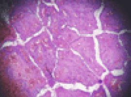 Study links changes in collagen to worse pancreatic cancer prognosis