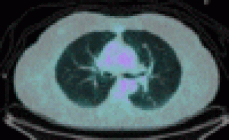 Quest for balance in radiation leads to lower CT doses