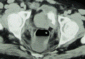 Targeted therapy erdafitinib effective for patients with advanced bladder cancer and specific gene mutations