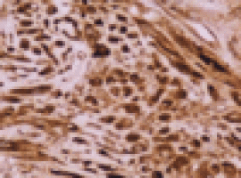 New drug active against most aggressive type of lung cancer cells