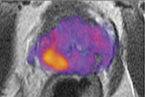 Active monitoring as effective for prostate cancer as surgery and radiotherapy, in terms of survival at 10 years