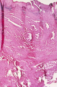 Understanding the resistance to treatments against breast cancer