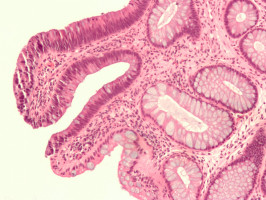 Researchers describe new condition involving numerous GI polyps in cancer survivors