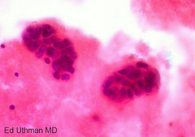 New study shows biopsy of recurrent breast cancer can alter treatment