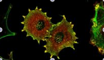 Study finds amplification of multiple cell-growth genes in some brain tumours