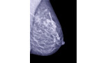 AACR 2015: US breast cancer cases expected to increase by as much as 50 percent by 2030
