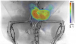 New imaging method to detect, monitor and guide prostate cancer treatment