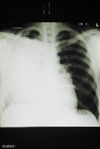 Combination drug therapy urged to battle lung cancer